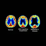 Las Vitaminas B y su Impacto en el Envejecimiento Cerebral