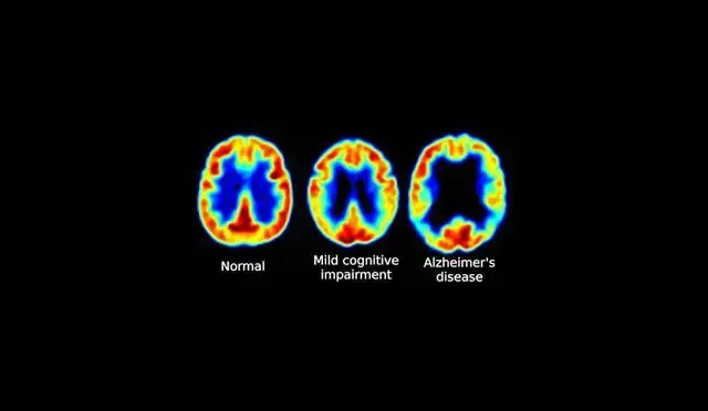 Las Vitaminas B y su Impacto en el Envejecimiento Cerebral